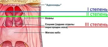 Що робити, якщо у дитини виявлено симптоми аденоїдів