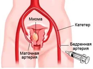 Що таке емболізація маткових артерій при міомі матки відгуки (матки) Що таке емболізація маткових артерій при міомі матки відгуки