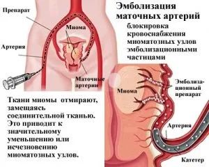 Що таке емболізація маткових артерій при міомі матки відгуки (матки) Що таке емболізація маткових артерій при міомі матки відгуки