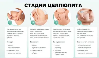 Що таке целюліт як він з'являється і як від нього позбутися