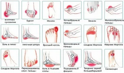 Що таке метатарзалгія стопи симптоми і лікування синдрому (стопи) Що таке метатарзалгія стопи симптоми і лікування синдрому