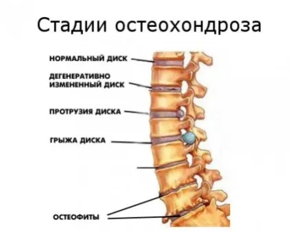 Що таке остеохондроз поняття, ступеня, можливе лікування (остеохондроз) Що таке остеохондроз поняття, ступеня, можливе лікування