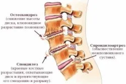 Деформуючийспондилоартроз симптоми і лікування (грудний відділ хребта) Деформуючийспондилоартроз симптоми і лікування