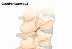 Деформуючийспондилоартроз симптоми і лікування (симптоми) Деформуючийспондилоартроз симптоми і лікування