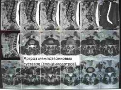 Деформуючийспондилоартроз симптоми і лікування (грудний відділ хребта) Деформуючийспондилоартроз симптоми і лікування