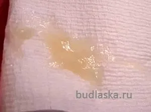 Cлізістая пробка при вагітності (фото) (слизова пробка відходить) Cлізістая пробка при вагітності (фото)