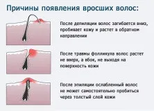 Депіляція зони бікіні в домашніх умовах воском, відео (депіляція) Депіляція зони бікіні в домашніх умовах воском, відео
