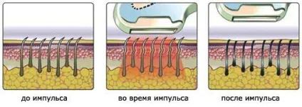 Депіляція зони бікіні в домашніх умовах воском, відео (зони) Депіляція зони бікіні в домашніх умовах воском, відео