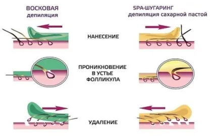 Депіляція зони бікіні в домашніх умовах воском, відео (депіляція) Депіляція зони бікіні в домашніх умовах воском, відео