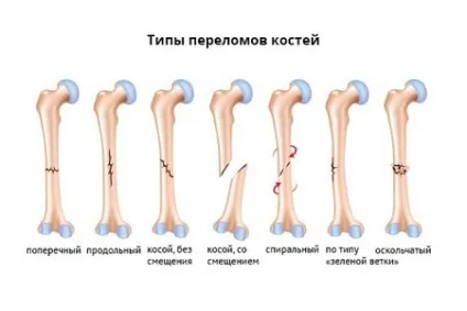 Деротаціонний чобіток при переломі шийки стегна ціна і фото (деротаціонний) Деротаціонний чобіток при переломі шийки стегна ціна і фото