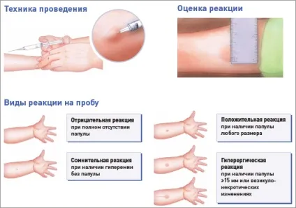 Діаскінтест (альтернатива пробі манту) (виражена реакція розмірі інфільтрату) Діаскінтест (альтернатива пробі манту)