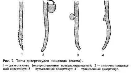 Дивертикул стравоходу симптоми, лікування, класифікація