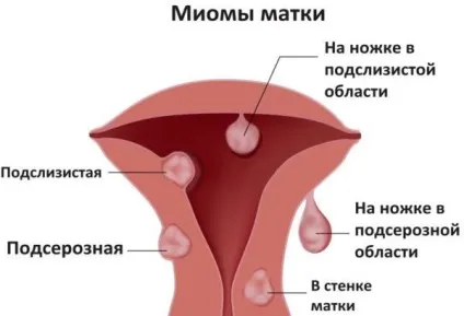 Тривале кровотеча після місячних причини, симптоми