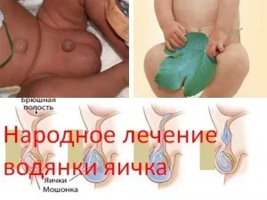 Народне лікування водянки яєчка, мій знахар (водянки) Народне лікування водянки яєчка, мій знахар