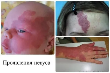 Найбільш поширені захворювання шкіри (найбільш) Найбільш поширені захворювання шкіри