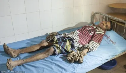 Чоловік почав перетворюватися в дерево через рідкісну хворобу