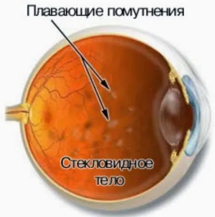 Мушки перед очима - як позбутися від мушок перед очима (позбутися) Мушки перед очима - як позбутися від мушок перед очима