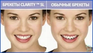 естетичні брекети