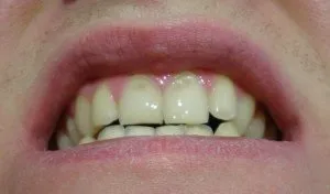 Ерозія емалі зубів причини, ознаки, лікування (традиційне і народне) фото (зубів) Ерозія емалі зубів причини, ознаки, лікування (традиційне і народне) фото