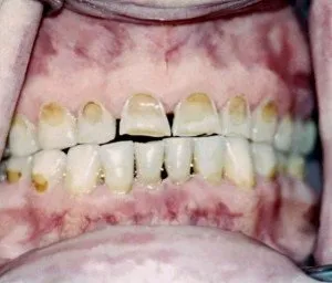Ерозія емалі зубів причини, ознаки, лікування (традиційне і народне) фото (ознаки) Ерозія емалі зубів причини, ознаки, лікування (традиційне і народне) фото