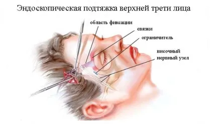 Ендоскопічна підтяжка верхньої, середньої і нижньої третини особи що це таке, ціни, фото до і після (верхньої) Ендоскопічна підтяжка верхньої, середньої і нижньої третини особи що це таке, ціни, фото до і після