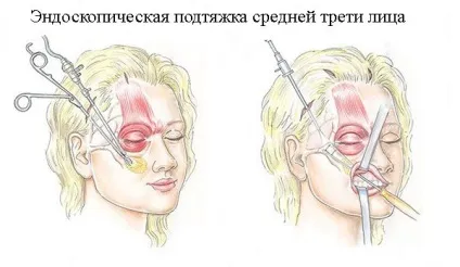 Ендоскопічна підтяжка верхньої, середньої і нижньої третини особи що це таке, ціни, фото до і після (ендоскопічний ліфтинг особи) Ендоскопічна підтяжка верхньої, середньої і нижньої третини особи що це таке, ціни, фото до і після