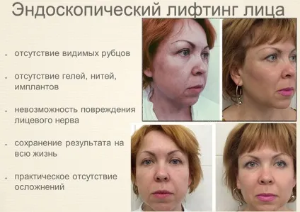 Ендоскопічний ліфтинг чола, брів, середньої зони особи відгуки, ціни (відгуки) Ендоскопічний ліфтинг чола, брів, середньої зони особи відгуки, ціни
