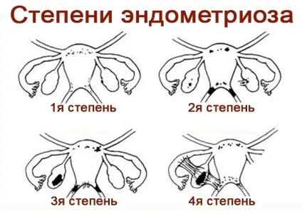 Ендометріоз на узі ознаки, коли робити щоб побачити (побачити) Ендометріоз на узі ознаки, коли робити щоб побачити