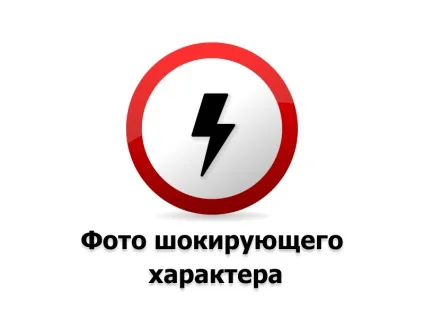 Ектопія яєчка що це таке і як виглядає на фото, як виявляється пахова і інші види ектопії (ектопія яєчко фото діти пахова праве) Ектопія яєчка що це таке і як виглядає на фото, як виявляється пахова і інші види ектопії