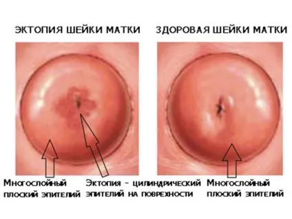 Ектопія (псевдоерозія) шийки матки причини, лікування, ускладнення (ектопія) Ектопія (псевдоерозія) шийки матки причини, лікування, ускладнення