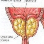 фіброз простати