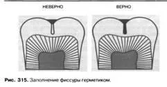Фіссурний герметики (Силантьєв)