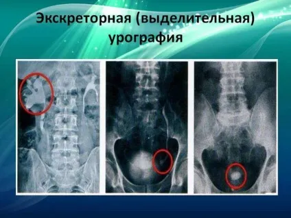 Фіброз нирки і що це таке помірний периметр фіброзу (нирки) Фіброз нирки і що це таке помірний периметр фіброзу