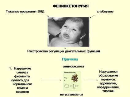 Фенілкетонурія причини, форми, симптоми, діагностика, лікування (симптоми) Фенілкетонурія причини, форми, симптоми, діагностика, лікування