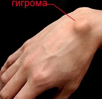 Гігрома що це таке, причини виникнення, лікування і видалення гігроми з внутрішньої сторони