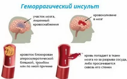 Геморагічний інсульт симптоматика, причини виникнення