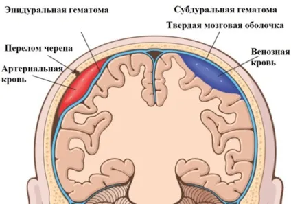 Гематома мозку лікування з операцією і без неї, здоров'я вашої голови (гематома) Гематома мозку лікування з операцією і без неї, здоров'я вашої голови