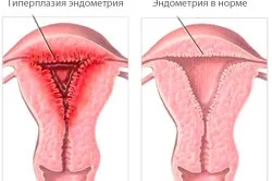 Гіперплазія ендометрію лікування народними засобами (лікування) Гіперплазія ендометрію лікування народними засобами