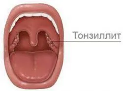 Гнійні пробки в мигдалинах причини, лікування (пробки) Гнійні пробки в мигдалинах причини, лікування