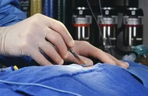 Гінекомастія симптоми, причини і ознаки у чоловіків (ознаки) Гінекомастія симптоми, причини і ознаки у чоловіків