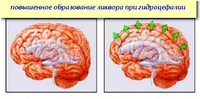 Гіпертензійного (гідроцефальний) синдром у дорослих і новонароджених дітей (мозок лінквор рідина синдром) Гіпертензійного (гідроцефальний) синдром у дорослих і новонароджених дітей