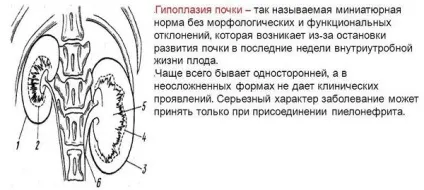 Гіпоплазія нирки (правої і лівої) ознаки, симптоми і лікування (гіпоплазія нирки правої лівої двостороння у дорослих дитини плода лікування) Гіпоплазія нирки (правої і лівої) ознаки, симптоми і лікування