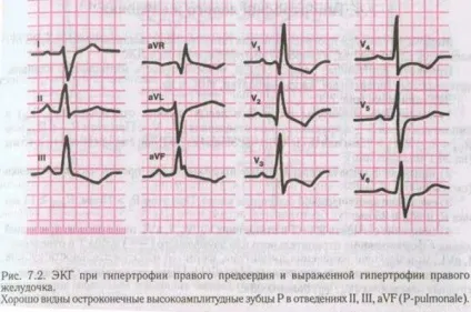 Гіпертрофія правого передсердя - причини, симптоми і лікування