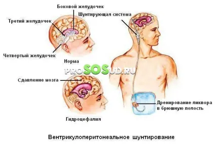 Гіпертензійного (гідроцефальний) синдром у дорослих і новонароджених дітей (новонароджених) Гіпертензійного (гідроцефальний) синдром у дорослих і новонароджених дітей