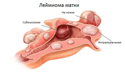 Інтрамуральна лейомиома матки що це таке, лікування (лейоміома) Інтрамуральна лейомиома матки що це таке, лікування
