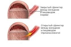 Печія ночами і вечорами причини