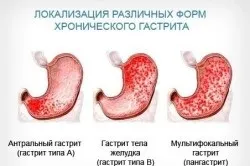 Печія ночами і вечорами причини