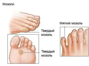 Як боротися з мозолями на ногах (мозолями) Як боротися з мозолями на ногах