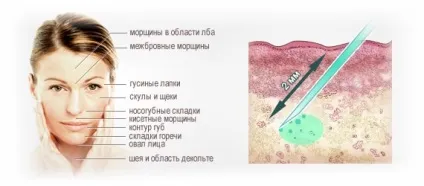 Як часто можна і потрібно робити биоревитализации (можна) Як часто можна і потрібно робити биоревитализации