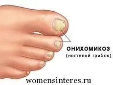 Нігтьової грибок (оніхомікоз) - лікування народними засобами, жіночий інтерес (грибок) Нігтьової грибок (оніхомікоз) - лікування народними засобами, жіночий інтерес